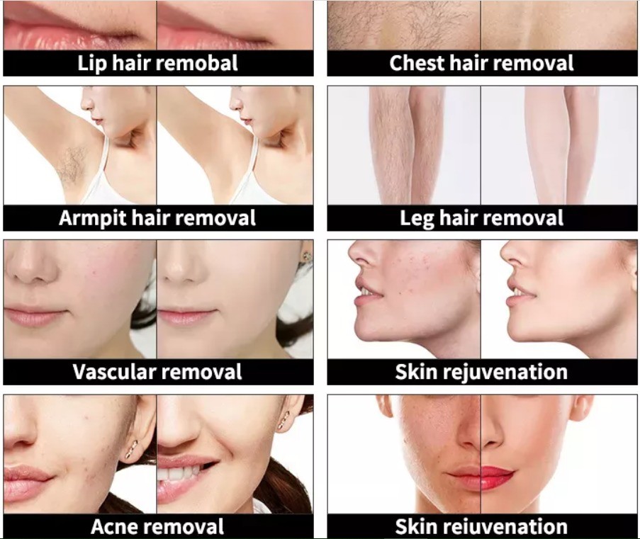 Multifunctional IPL RF DIODE LASER ND YAG LASER tattoo removal and hair removal skin rejuvenation salon use