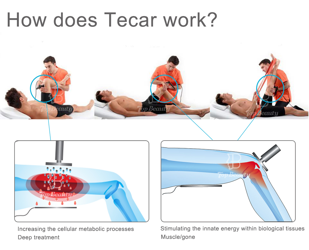 Ankle Pain Management Tecar Therapy Machine Intelligent Ring Simultaneous Operation