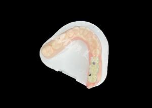 Wholesale PFM Dental Crowns Lifelike and Corrosion Resistant for Optimal Oral Health from china suppliers