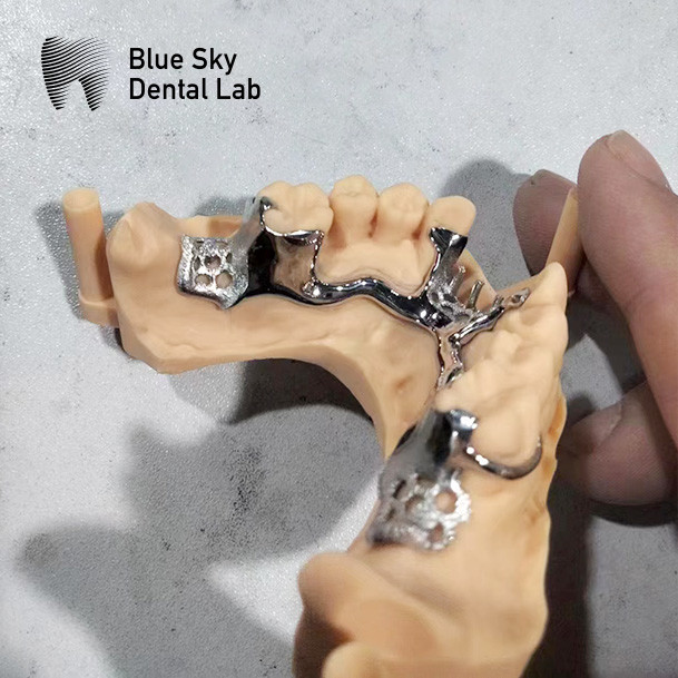 Skelete Chrome Metal Partial Denture Printed CoCr Denture Design