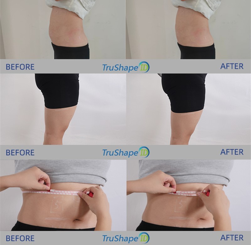 Monopolar Rf Beauty Equipment Non Invasive Trueshape Body Sculpting Trusculpt Id
