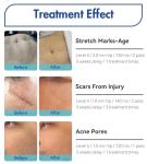 Golden Nano Fractional RF Microneedling Devices For Home Acne Removal