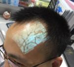Medical Professional Infrared Vein Viewer Transilluminator Find Veins For