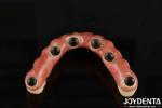 Dental Titanium Malo Implant Bridge Combining Traditional And Modern Techniques