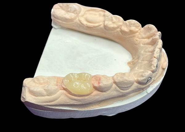 Custom Smooth Dental Ceramic Inlay for Staining Resistant Seamless Tooth Repair