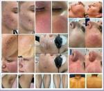 Skin rejuvenation Laser Multifunction Beauty Machine M22 OPT IPL Hair Removal