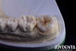 Natural Color Accurate Fit Dental Inlay For Damaged Teeth Restoration