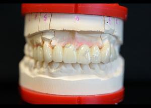 Wholesale Strength Natural Esthetics Solid Zirconia Crown Perfect Fit for Single or Multiple Teeth from china suppliers