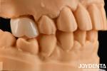 Natural-looking Esthetics With Biocompatible Dental Zirconia Winning Combination