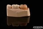 Dental Restoration Material Multilayer Full Zirconia 1200 HV Hardness Crack