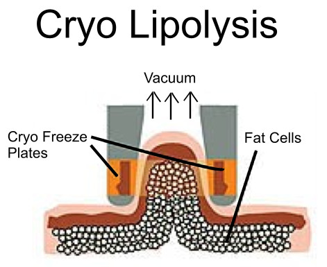 Cold zero cryo lipo laser machineCryolipolysis body slimming machine