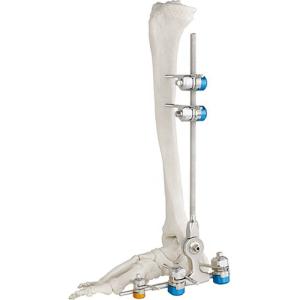 Wholesale Medical Bone Hammer External Fixation Device Ankle Fracture from china suppliers