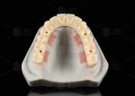 Translucent Full Contour Zirconia Bridge Over Milled Implant Bar Customized