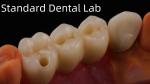 Professional Zirconia Dental Implant Crown Titanium CAD CAM Zirconia Crown China