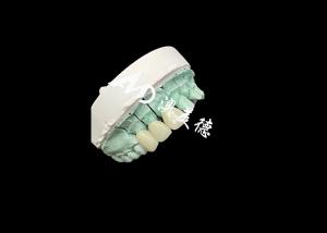 Wholesale Emax Ceramic Crown Customizable and Affordable Solution for Dental Restoration from china suppliers