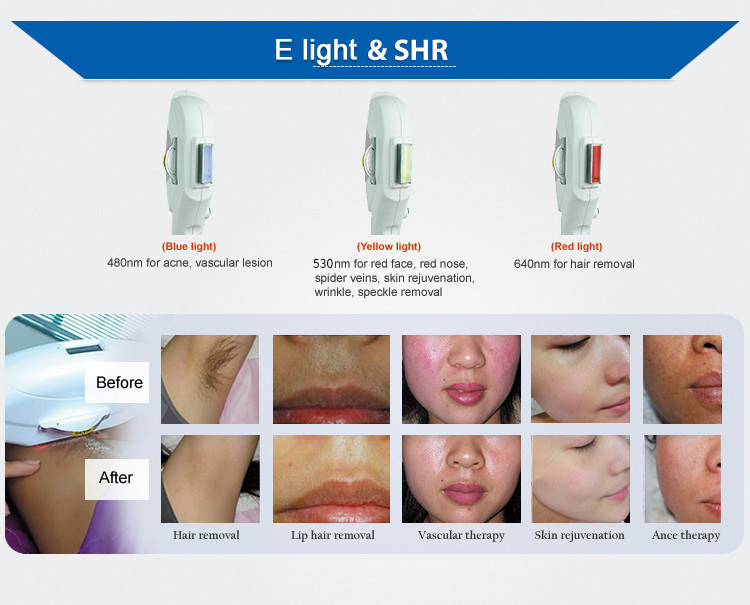 Elight Nd Yag Rf Ipl OPT Laser Hair Removal Machine for Vascular Removal