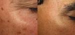 1064nm 532nm 1320nm Nd Yag Laser Equipment Portable For Skin Whitening