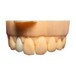 Chromecast Safety PFM Dental Crown Bridge Good Biocompatibility