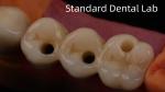 Professional Zirconia Dental Implant Crown Titanium CAD CAM Zirconia Crown China