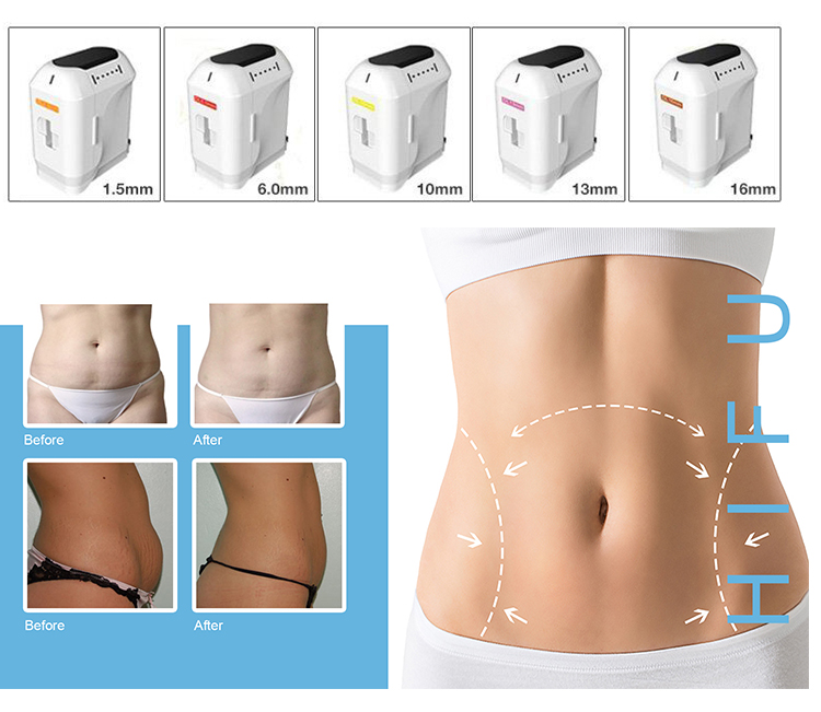 New technology hifu machine three cartridges portable 5D ice HIFU hifu ultrasound