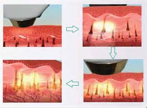 Hair Removal 808nm Diode Laser Beauty Equipment