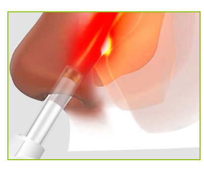 5V1A 5V2A Allergy Nasal Laser Therapy Device Diabetes Cure Rhinitis Therapy Machine