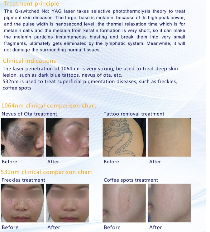 FDA TGA Medical CE approved Q switch nd yag laser for sale