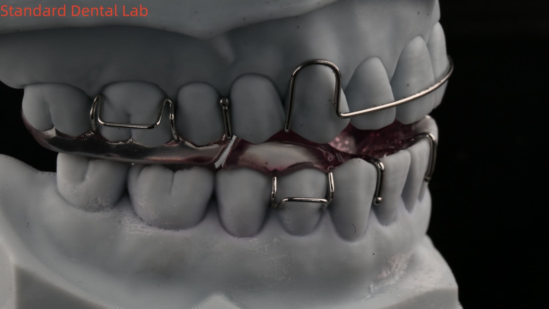 Teeth Expansion And Distalization Adjusting Expander In Mouth Orthodontist Palate Expander