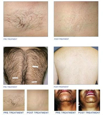 diode laser for hair removal 808nm beauty machine depilight