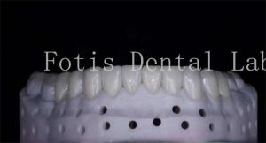 Wholesale OEM ODM Stain Resistant Natural Looking Porcelain Veneers High Strength from china suppliers