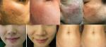 radio frequency microneedle rf skin tightening beauty machine