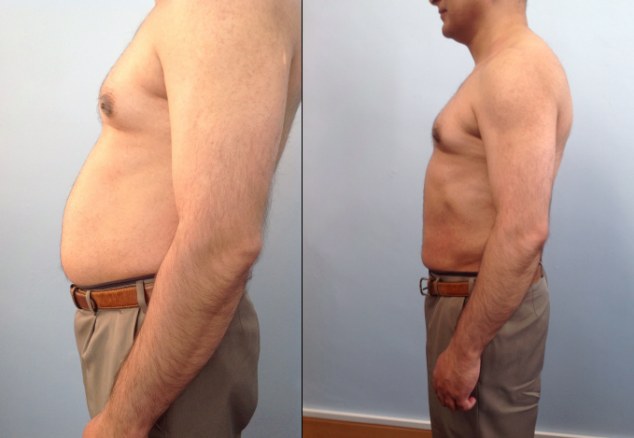 hifu treatment results