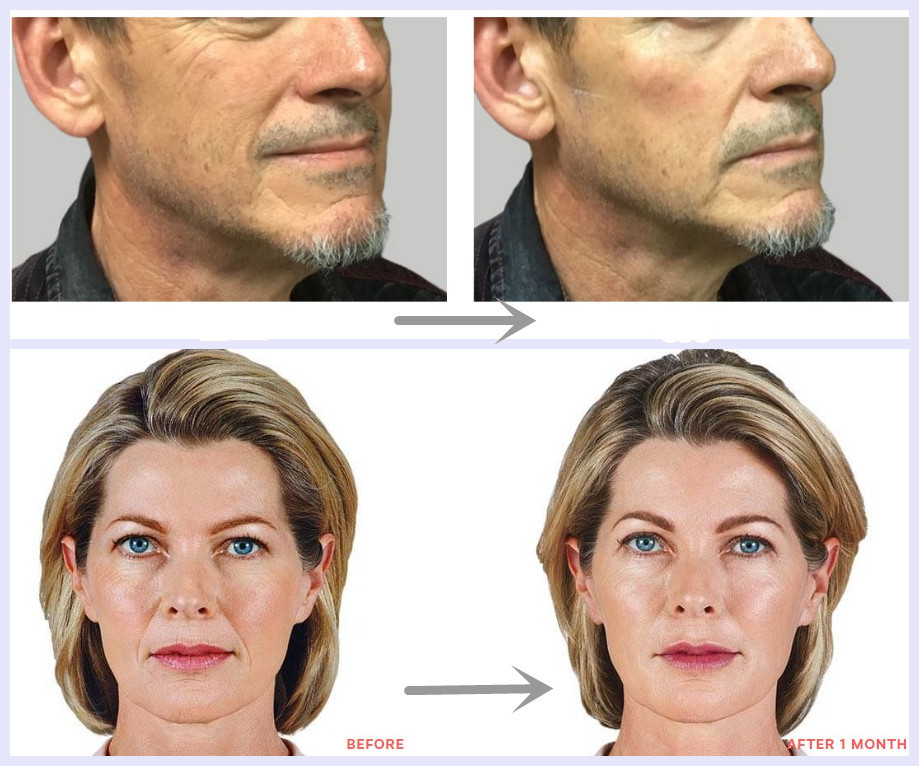 Chin Cheek Injection Cross Linked Juvederm Voluma Dermal Filler
