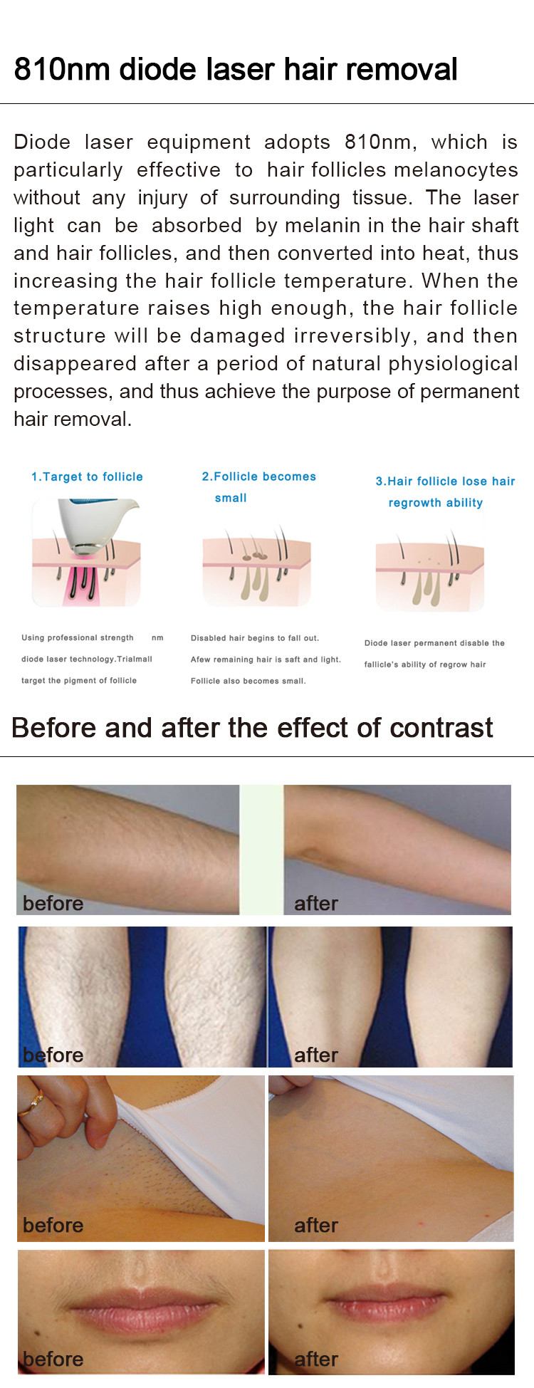 Pianless 808nm diode laser permanent hair removal 2000W power laser hair removal machine LF-648