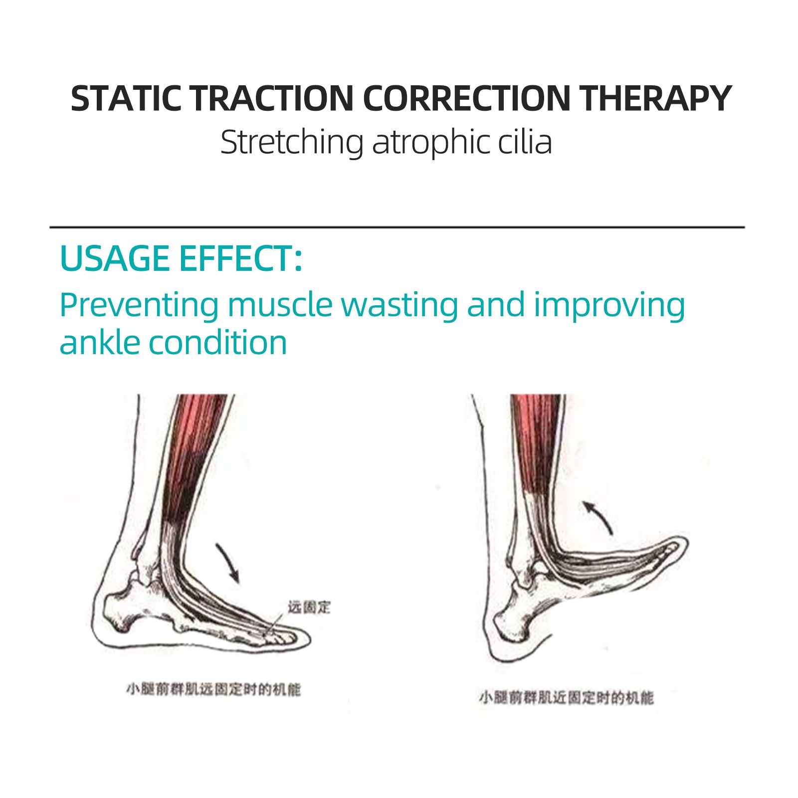 Ankle post-surgery hemiplegia stiffness foot drop dorsiflexion large angle exercise pulling tendon trainer