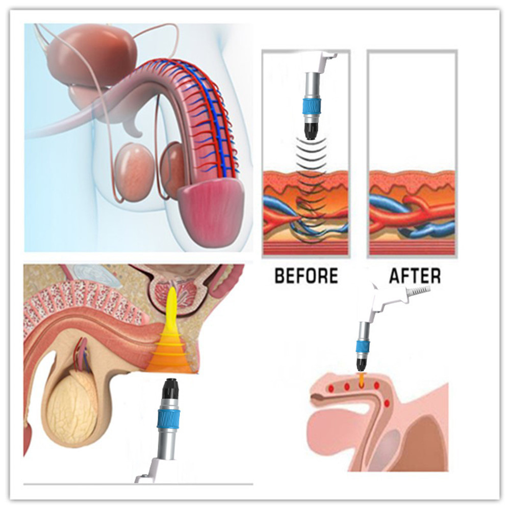 Extracorporeal Air Pressure Therapy Machine Acoustic Wave Type For Sports Injury Recovery