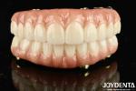 High Durability Ti-Bar Zirconia Hybrid Bridge The Ultimate Choice for Achieving