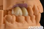 Porcelain Implant Crown and Bridge The Ultimate Solution for Restoration Of