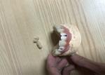Accurate Biocompatibility Dental Implant Attachments Tooth Implant Crown