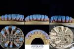 High Biocompatibility Feldspathic Ceramic Veneer Glossy For Dental Restorations