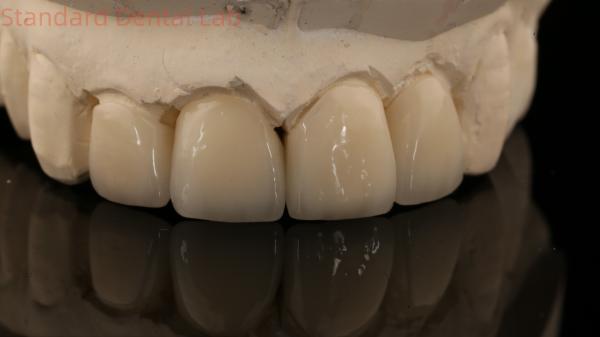 Strong Layered Zirconia Crown And Bridge In Good Esthetics Zirconia Layered