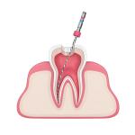 Engine Use Dental Endo Niti Files With Nanometer Coating