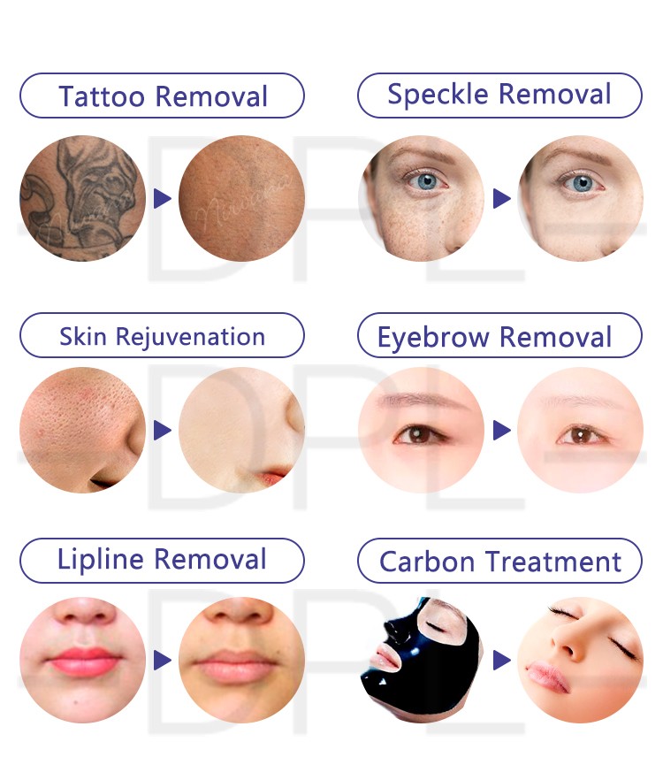 DPL New design most popular active q switched nd yag laser portable device eyebrow removal picosecond machine