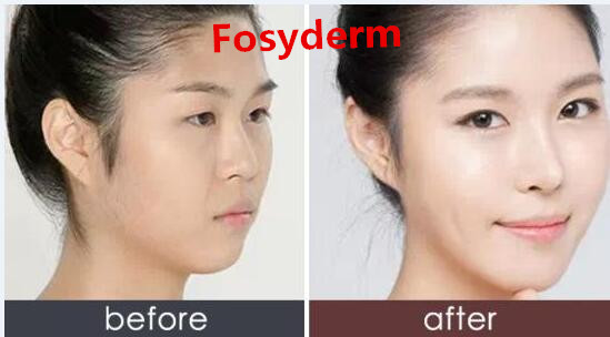Sexy Lip Augmentation Hyaluronic Acid Dermal Filler No Side Effect Lip Filler