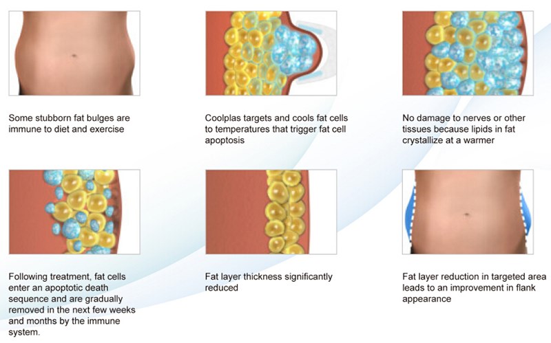 coolscupting zeltiq cryolipolysis fat freezing and shockwave slimming Coolplas vacuum cryotherapy fat freezing
