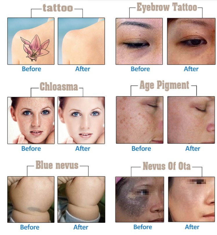 Multifunctional IPL RF DIODE LASER ND YAG LASER tattoo removal and hair removal skin rejuvenation salon use
