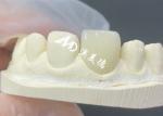 Durable and Aesthetic EMAX Veneer The Perfect Solution for Porcelain Restoration