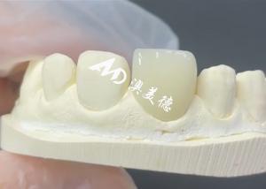 Wholesale Durable and Aesthetic EMAX Veneer The Perfect Solution for Porcelain Restorations from china suppliers