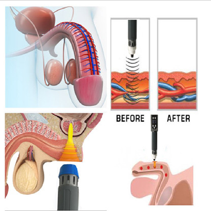 ED Treatment 14 Tips 16Hz Electromagnetic Therapy Machine