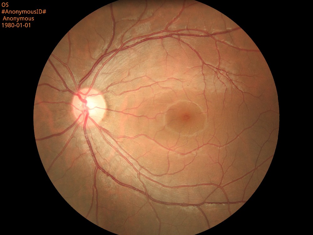 Portable Digital Fundus Camera with Ce Approval (HA06)